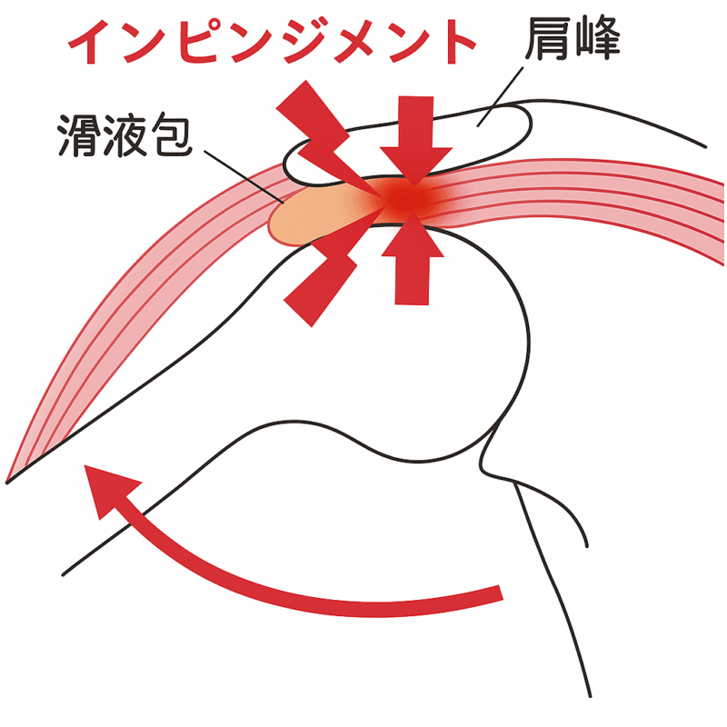 肩関節のインピンジメント症候群を説明する医学的図解。肩峰と上腕骨の間で滑液包が挟まれている状態を赤い矢印で示し、炎症部分が赤く着色されている解剖図。